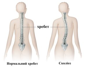 Міжнародний день боротьби зі сколіозом