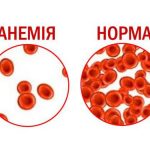 Анемія - це серйозно? Анемія - це серйозно?
