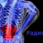 Радикуліт: причини розвитку хвороби Радикуліт: причини розвитку хвороби