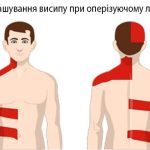 ОПЕРІЗУЮЧИЙ ЛИШАЙ ОПЕРІЗУЮЧИЙ ЛИШАЙ