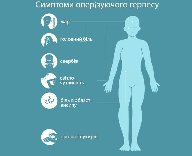 Оперізуючий лишай або герпес: симптоми та лікування