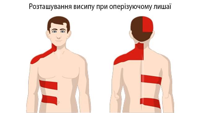 Оперізуючий лишай або герпес: симптоми та лікування