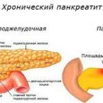 Що таке панкреатит