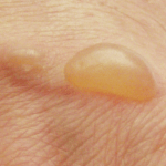 Опік, перша допомога