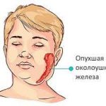 Епідемічний паротит