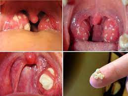 Захворювання глотки