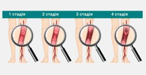 Тромбофлебіт