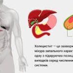 Холецистит