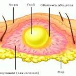 Флегмона Флегмона