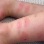 Як уберегтися від укусів комах