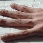 Муковісцидоз