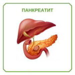 Панкреатит Панкреатит