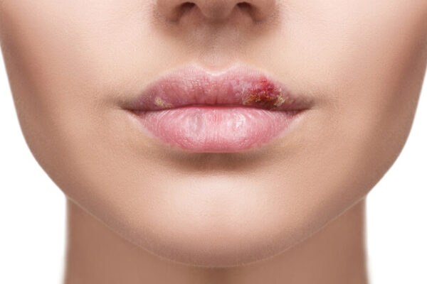 Як лікувати герпес – поради лікаря