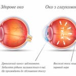 ГЛАУКОМА ГЛАУКОМА