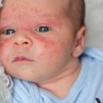 АТОПІЧНИЙ ДЕРМАТИТ У ДІТЕЙ