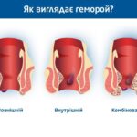 Геморой
