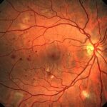 Діабетична ретинопатія