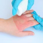 ОПІКИ ШКІРИ: ПРАВИЛА ПЕРШОЇ ДОПОМОГИ ТА ЛІКУВАННЯ