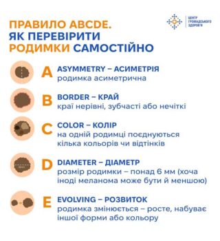 2melanoma