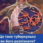 Що таке туберкульоз і як його розпізнати? Що таке туберкульоз і як його розпізнати?
