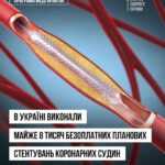 В Україні виконали майже 8 тисяч безоплатних планових стентувань